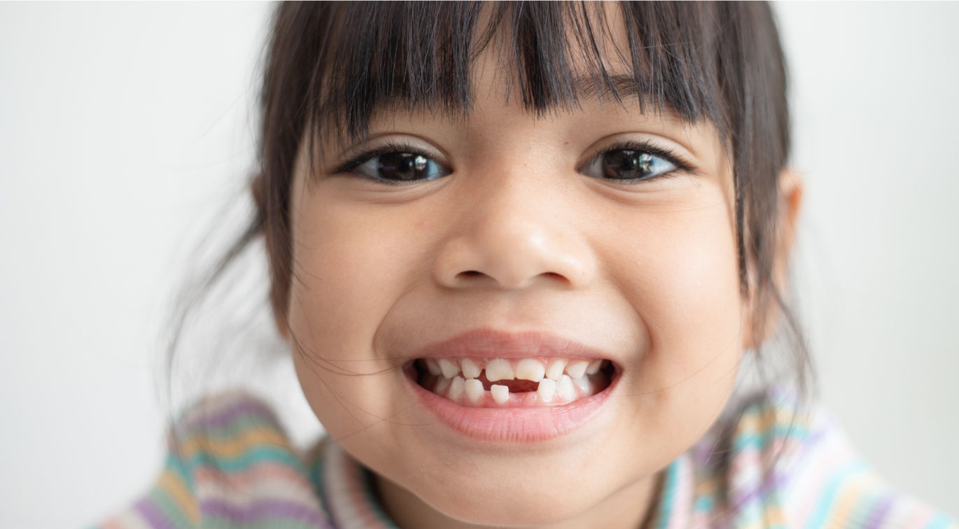 Kid smiling and showing off a dental milestone losing two baby teeth.